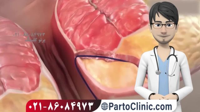 فيلم عمل جراحی فیستول مقعدی با لیزر-partoclinic