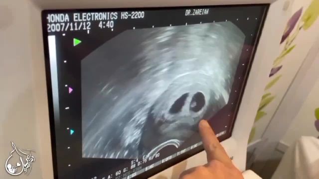حاملگی دوقلو با آی وی اف و اهدای تخمک در 37 سالگی مادر