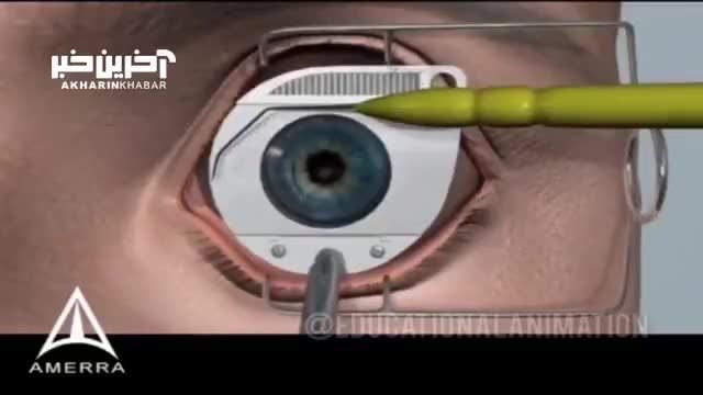 انیمیشن عمل لیزیک چشم انسان