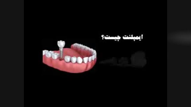ایمپلنت دندان (کاشت دندان)