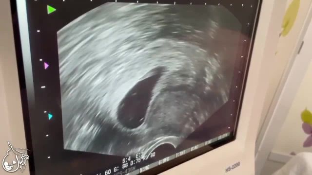 بارداری با اولین سیکل IVF در سن 35 سالگی بعد از 14 سال نازایی