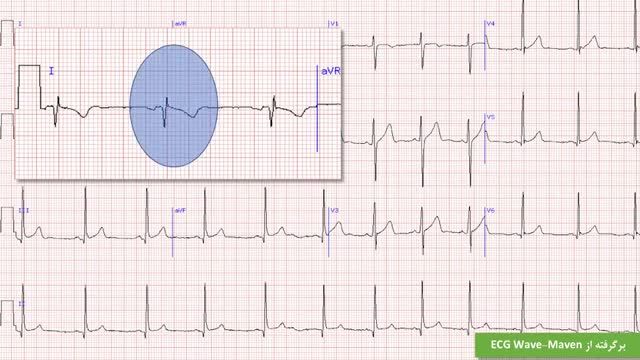 تمرین نوار قلب (الکتروکاردیوگرام) | بخش 2