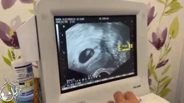 بارداری با IVF و اهدای جنین