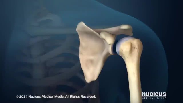 دانستنی های درد آرتریت شانه | ویدیو