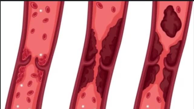علائم ترومبوآمبولی چیست؟ | لخته شدن خون یا ترومبوآمبولی را با مصرف مواد گیاهی درمان کنید