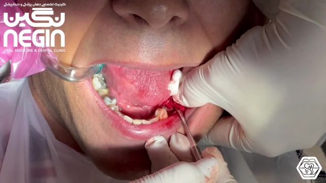 بستن سه واحد هیلینگ - دکتر نگین اثنی عشری جراح دندانپزشک
