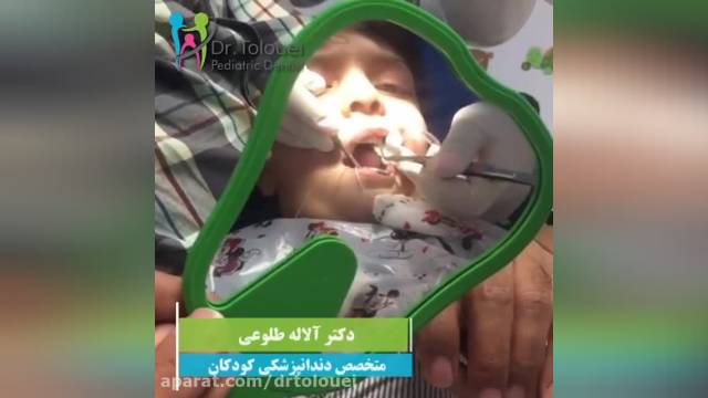 عصب کشی دندان کودک در تهران