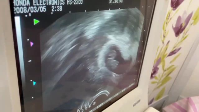 حاملگی با آی وی اف و اهدای تخمک با استفاده از رحم جایگزین با تشخیص رحم فیبر‌ماتوس