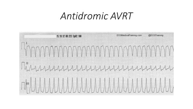 علل تفاوت AVRT و AVNRT در WIDE QRS | دکتر گرایلی