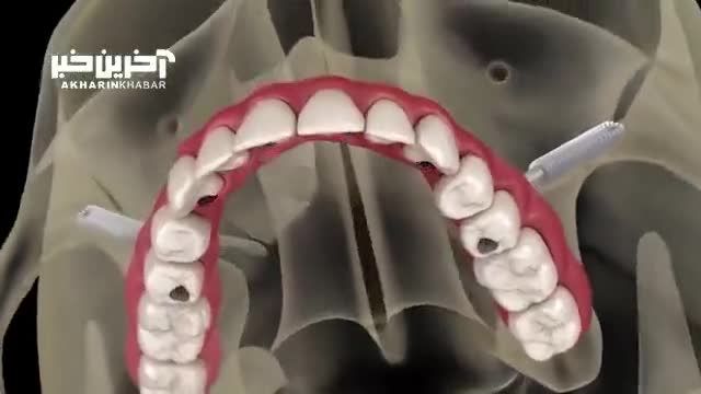 نرم افزار تشخیص خطای کاشت دندان توسط گروهی از فناوران جهاد دانشگاهی