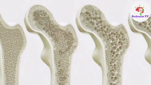 بررسی کامل پوکی استخوان از علل، تشخیص و درمان های خانگی پوکی استخوان