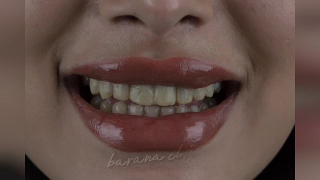تفاوت قبل و بعد از انجام لمینت دندان مشهد