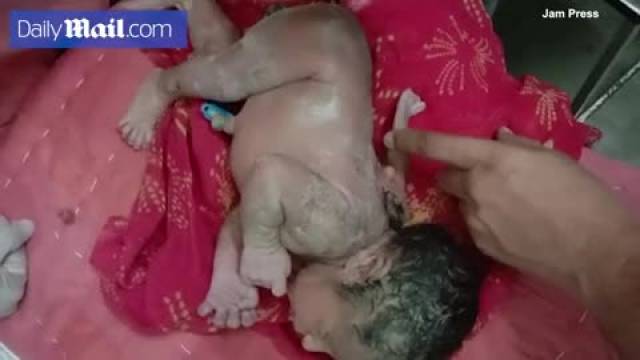 تولد نوزاد پسر با سه دست در هند | ویدیو