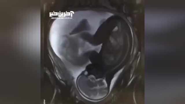 ویدئویی جالب از ام آر آی (MRI) جنین
