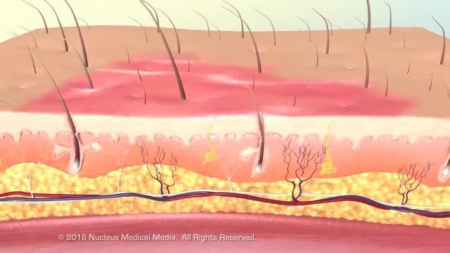 سوختگی چگونه طبقه بندی و درمان می شود | ویدیو