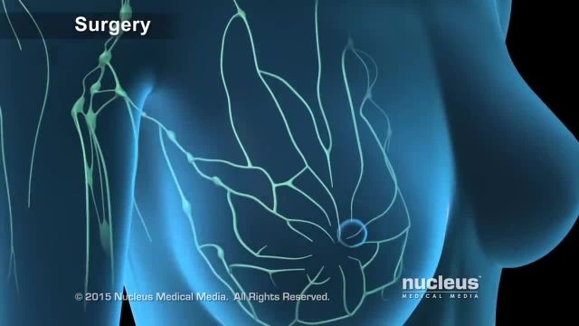 درمان های سرطان سینه | ویدیو