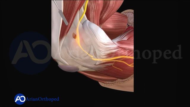 جراحی سندرم تونل کوبیتال | فشار عصب اولنار در ناحیه داخلی آرنج