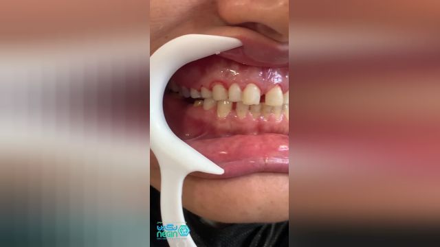 قبل از انجام لمینت دندان | کلینیک دندانپزشکی نگین
