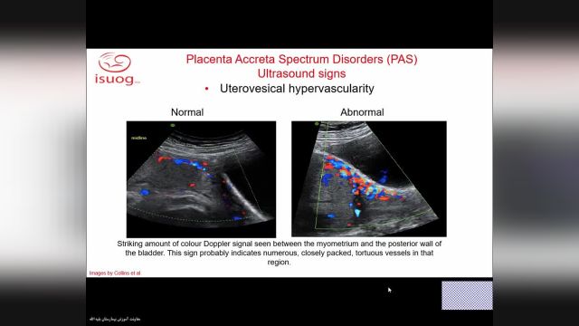 چسبندگی غیر طبیعی جفت (جفت اکرتا) | اپیدمیولوژی، تشخیص، درمان و جراحی| Placenta Accreta