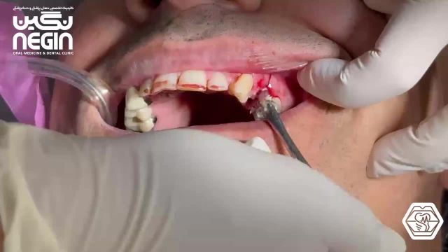 جراحی Socket Preserve برای قبل از کاشت ایمپلنت دندان