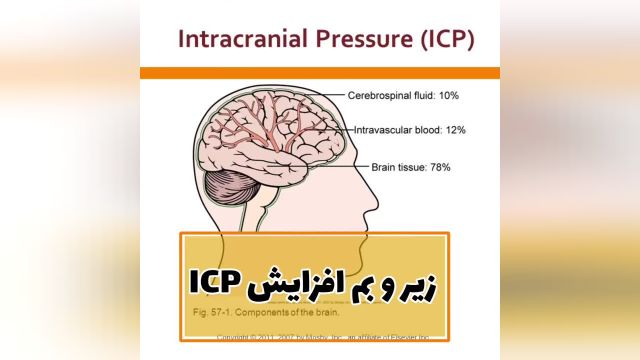 همه‌ چیز راجع به افزایش فشار خون داخل جمجمه ICP