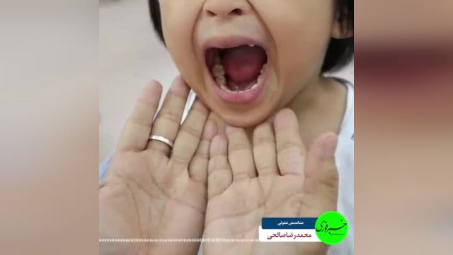 شیوع بیماری دست، پا و دهان در بین کودکان | ویدیو