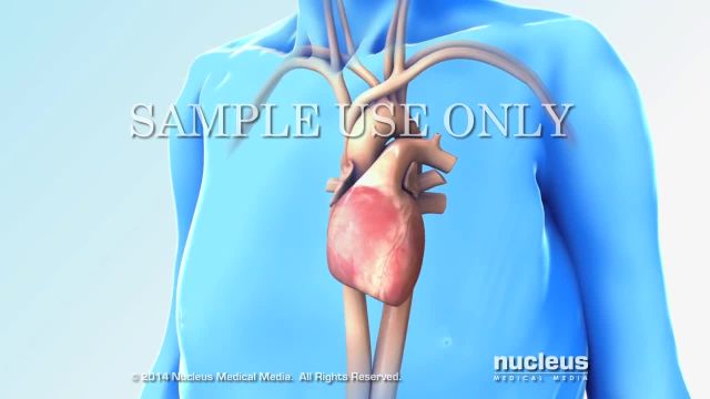 دستورالعمل تخلیه برای نارسایی قلبی | ویدیو