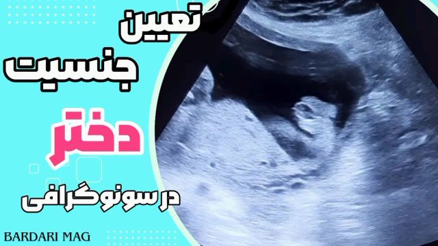 تعیین جنسیت دختر در سونوگرافی | سونو جنین دختر را در این ویدیو ببینید!