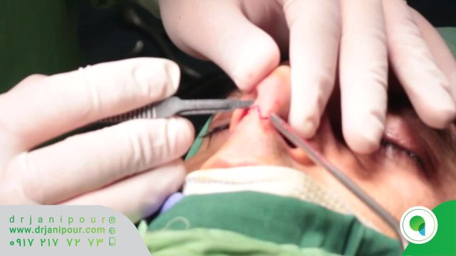 ویدیو جراحی زیبایی بینی در اتاق عمل | دکتر مسعود جانی پور