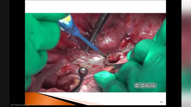 وبینار جامعی از روش های نوین جراحی HIPEC و CSR | ویژه متخصصین