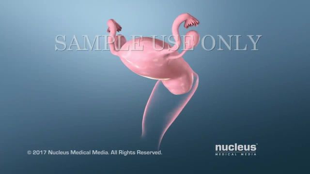 انیمیشنی درباره تست پاپ و HPV | ویدیو