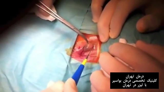 درمان بواسیر خارجی  - درمان تهران