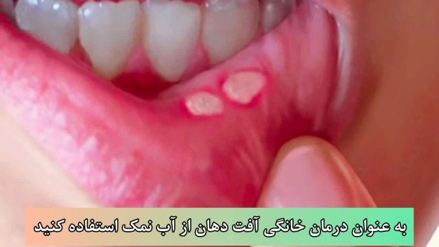 آفت دهان چیست؟ | علائم و درمان فوری آفت دهان
