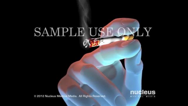 سیگار باعث سرطان، بیماری قلبی، آمفیزم می شود | ویدیو
