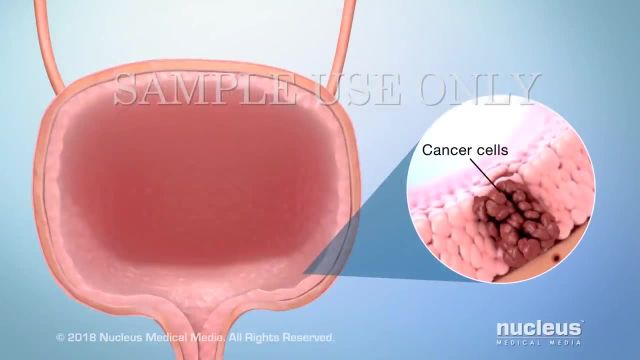 درمان سرطان مثانه به روایت تصویر | ویدیو