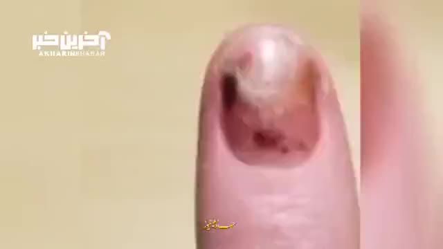 روند جالب بهبود ناخن شکسته انگشت را ببینید