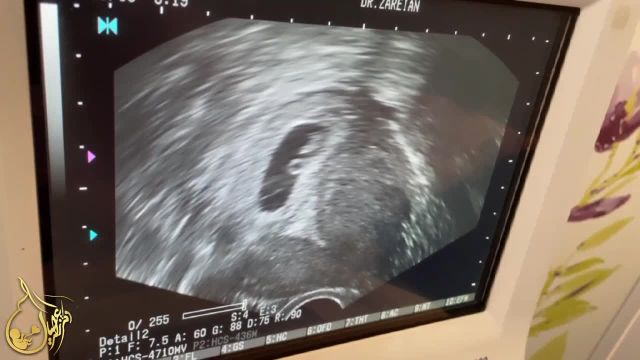 بارداری در اولین سیکل آی وی اف برای مادر 29 ساله