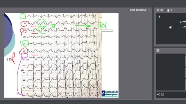 وبینار تشخیص های افتراقی در ECG به همراه ارائه 50 و نوار قلب مختلف | دوره آموزش نوار قلب (جلسه 7از7)