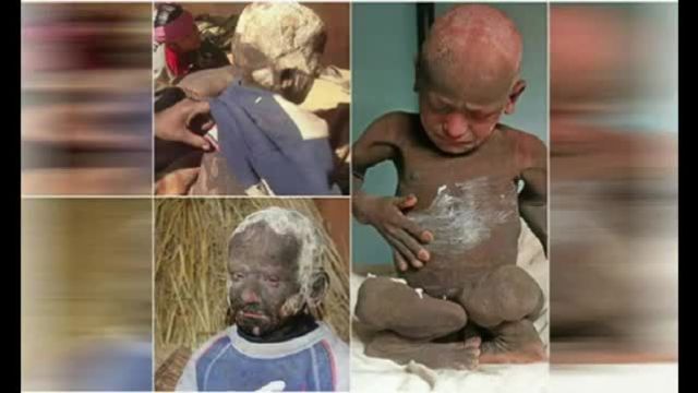 بیماری خاص پسر نپالی | پوست بدن این پسر سنگ تولید می کند!