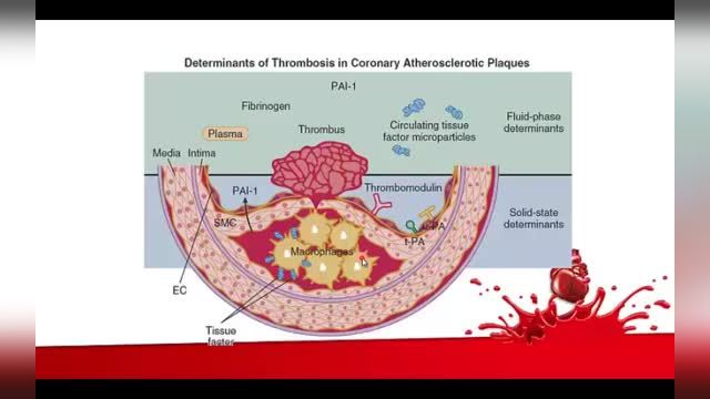 بررسی بیماری شریان کرونری (Coronary Artery Disease) | بخش اول