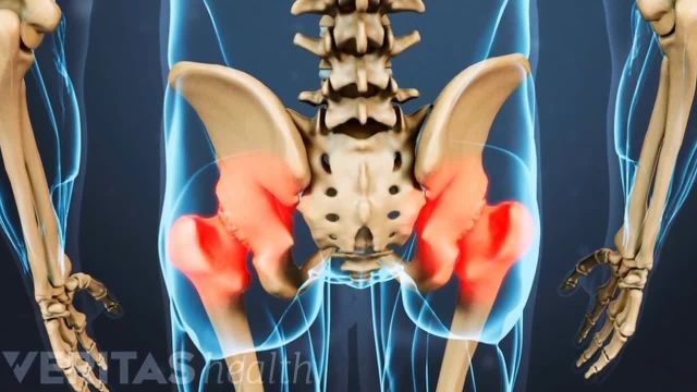 ساییدگی مفصل لگن چیست؟ | علت درد لگن یا آرتروز لگن چیست؟