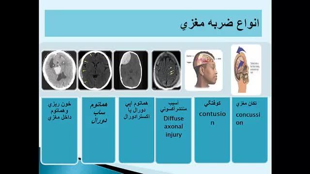 مراقبت های ویژه در مشکلات بالینی مغز و اعصاب (3)
