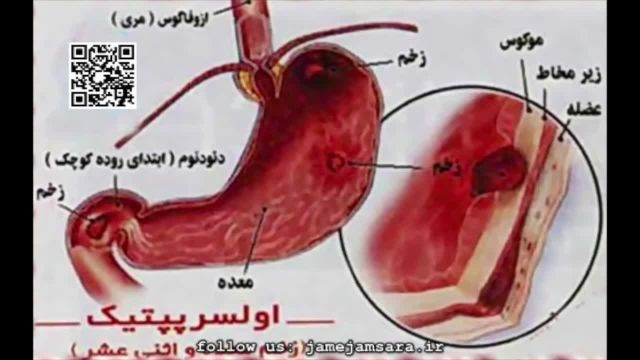 زخم معده چیست و راه های درمان آن کدام ست؟