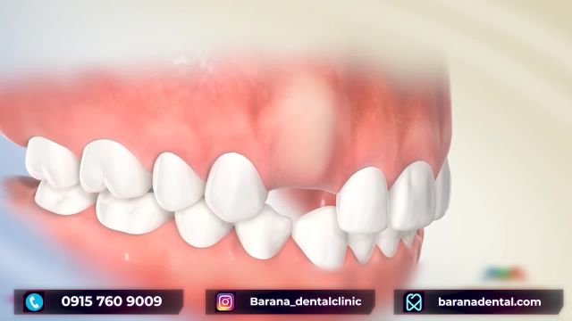 دندان نیش نهفته چگونه درمان می شود؟