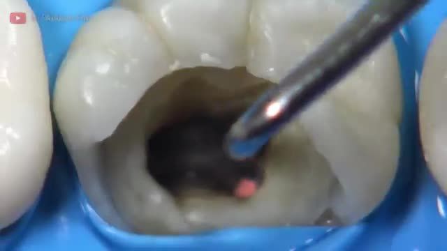 ویدیویی از روند ترمیم دندان آسیب دیده از پوسیدگی