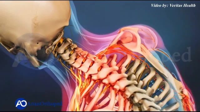 ویدیو تنگی کانال نخاع گردن | فشار به نخاع در ناحیه گردن