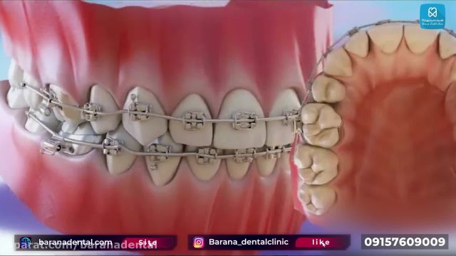 کشیدن دندان برای ارتودنسی چگونه انجام میشود؟