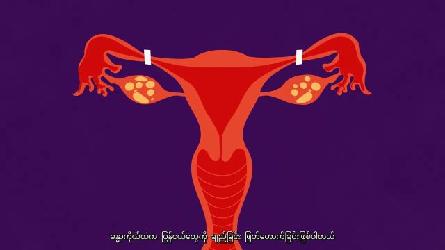 درباره پیشگیری از بارداری در برمه