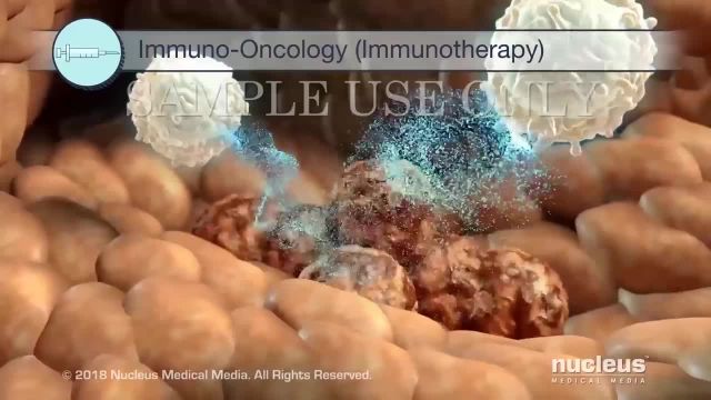 درمان سرطان پروستات به روایت تصویر | ویدیو