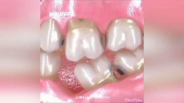 پوسیدگی دندان چگونه اتفاق می افتد ؟ + فیلم